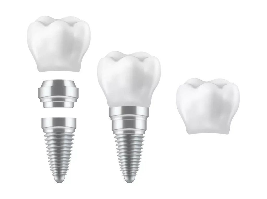 Tratament Parodontoza Dentara Clinica Stomatologica SteliDental Braila 10