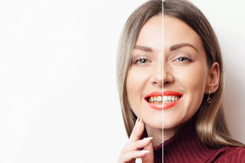 Articol Dinți îngălbeniți 1