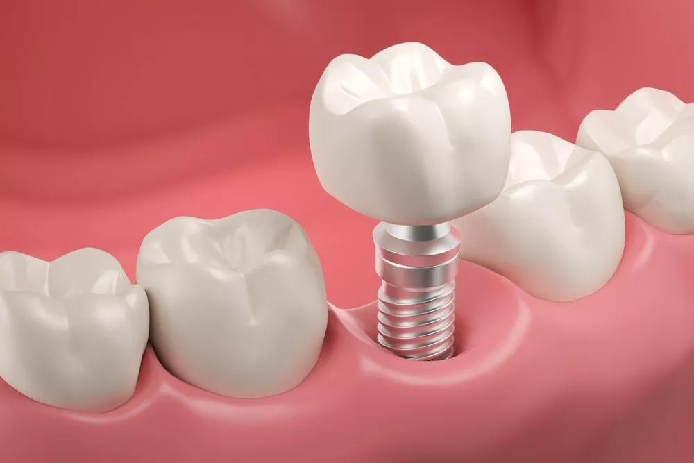 Care Este Durata De Viață A Unui Implant Dentar