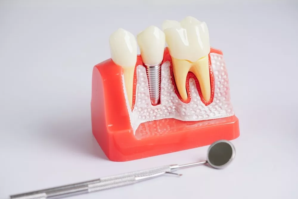 Cât Durează Procedura De Implant Dentar La SteliDental