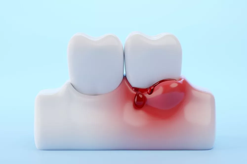 Ce Fac Dacă îmi Sângerează Gingiile Este Semn De Boală Parodontală