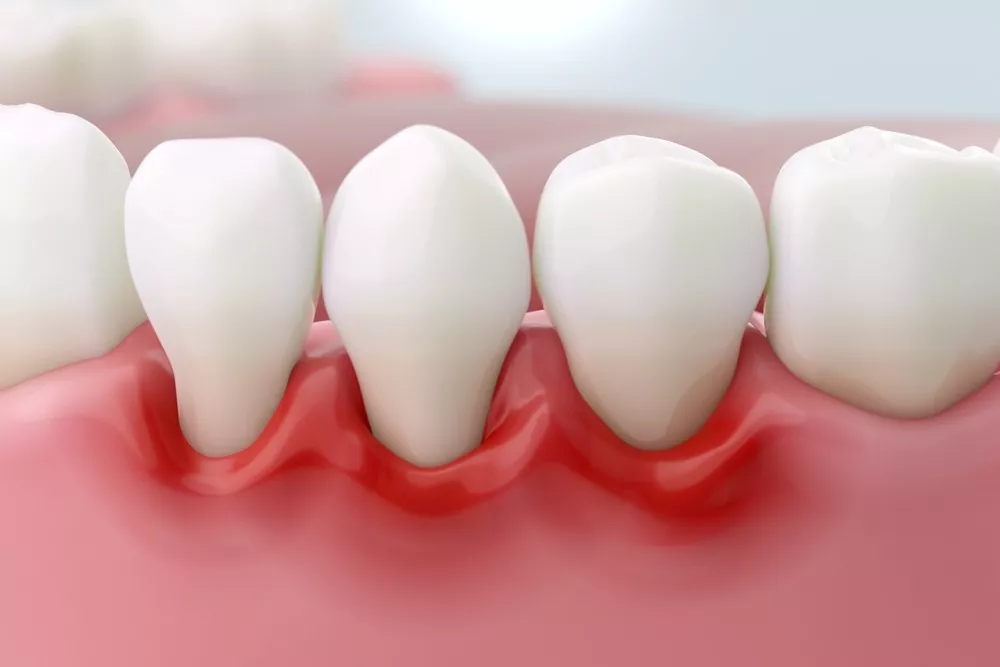 Ce Fac Dacă îmi Sângerează Gingiile Este Semn De Boală Parodontală1