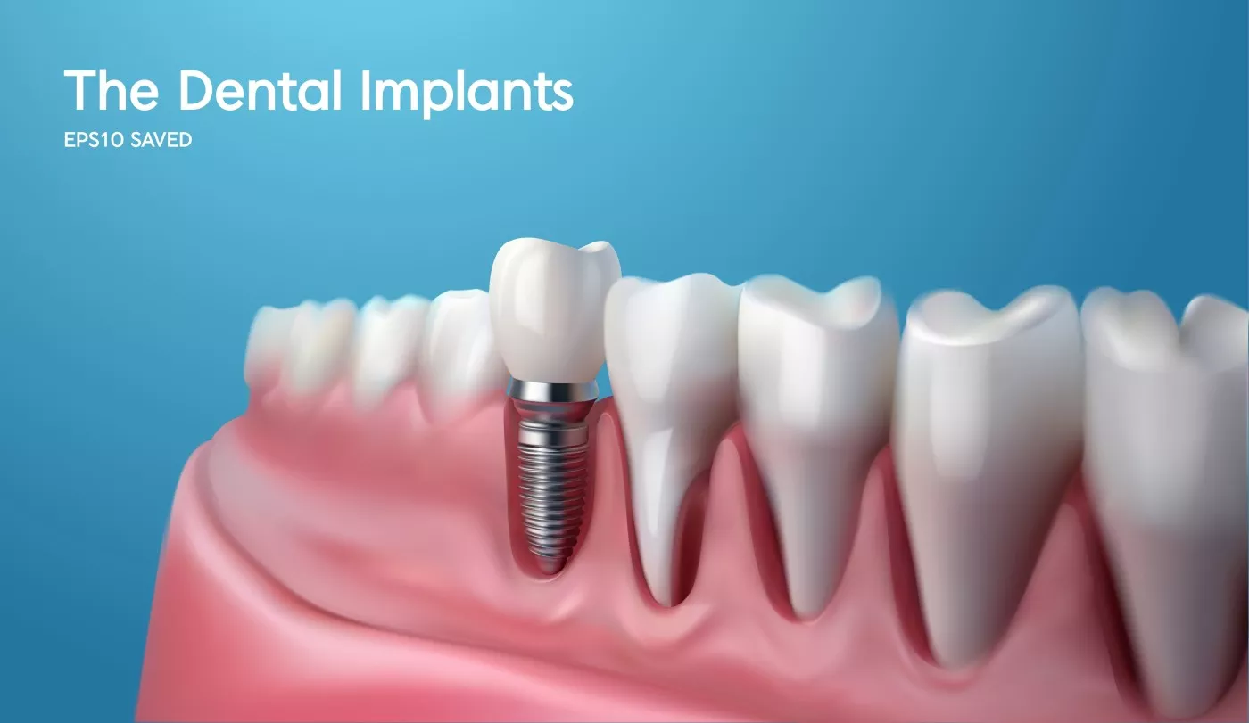 Ce Presupune Ingrijirea Implanturilor Dentare Dupa Interventie