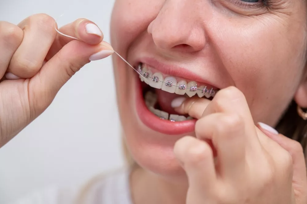 Cum Pot Mentine O Igiena Orala Adecvata Atunci Cand Port Aparat Dentar