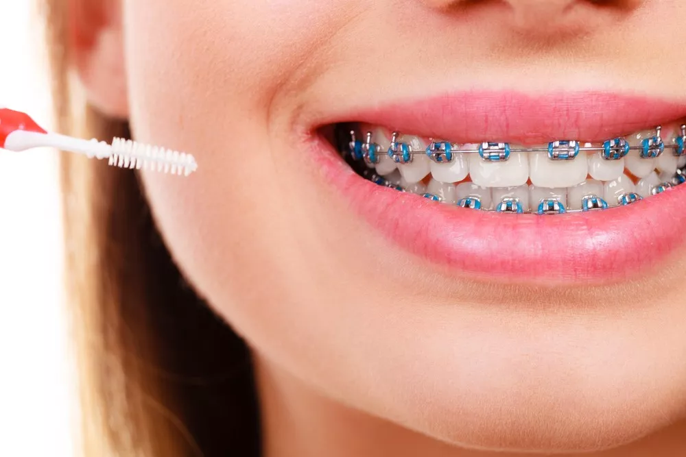 Cum Pot Mentine O Igiena Orala Adecvata Atunci Cand Port Aparat Dentar1 693005e7ae47d