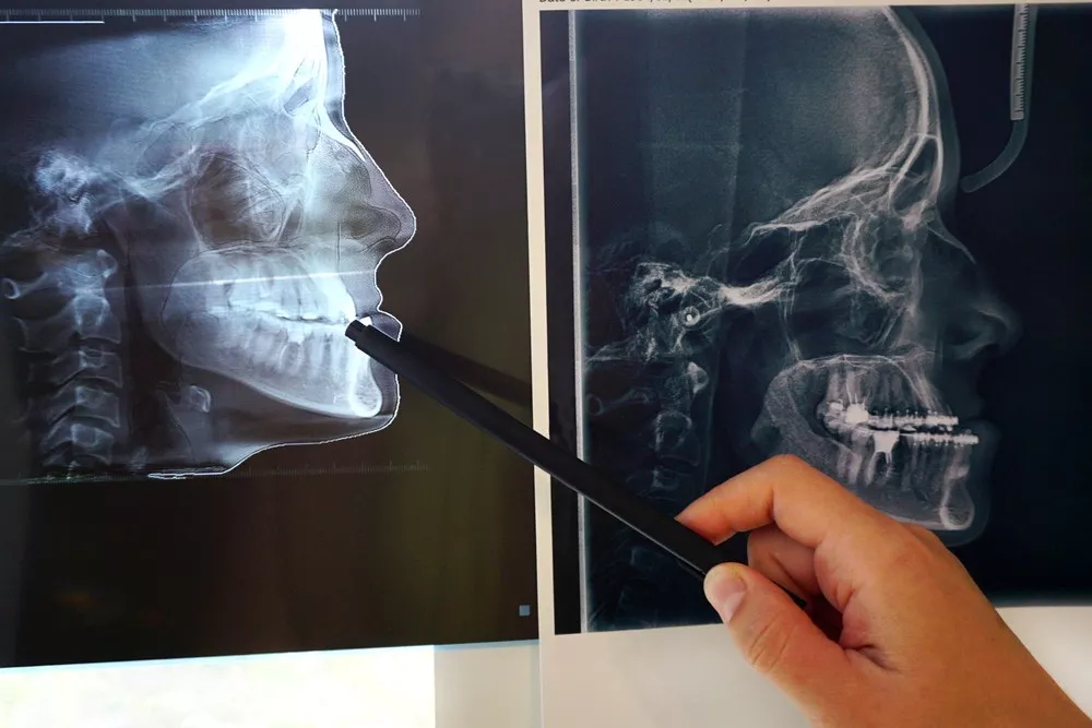 Cum Se Alege Tipul De Aparat Ortodontic Potrivit Pentru Fiecare Pacient La Stelidental Braila