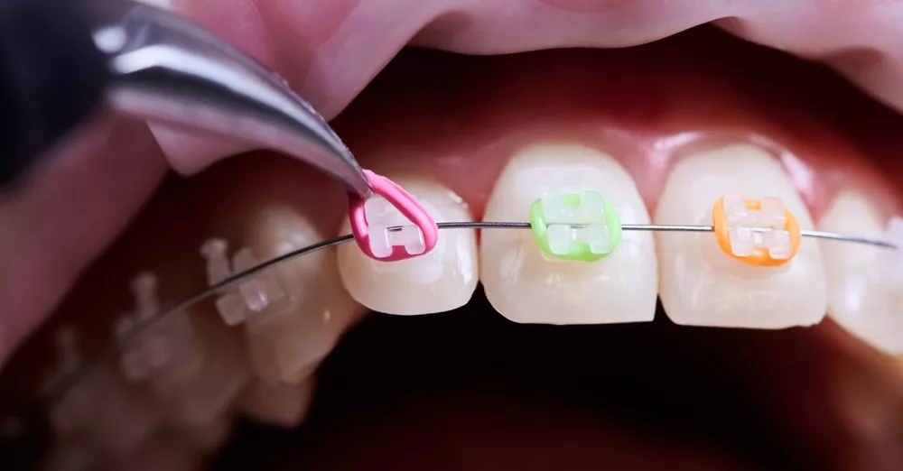 Cum Se Schimba Rutina De Ingrijire Orala Cu Un Aparat Dentar De La Stelidental